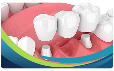 Dental Bridges Specialist Near Me in San Jose, CA