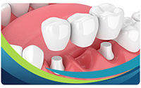 Dental Bridges Specialist Near Me in San Jose, CA