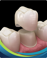 Dental Crowns Near Me in San Jose, CA