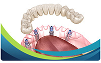 Implant Retained Dentures Specialist Near Me in San Jose, CA