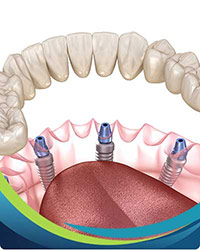 Implant Retained Dentures Near Me in San Jose, CA