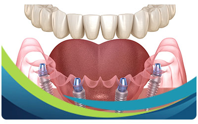 Types of Dental Implants Near Me in San Jose CA Types of Dental Implants Near Me in San Jose CA