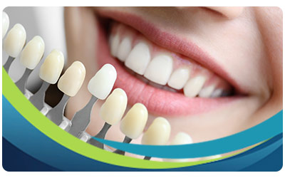 What Is the Cost of Veneers per Tooth Near Me in San Jose, CA What Is the Cost of Veneers per Tooth Near Me in San Jose, CA