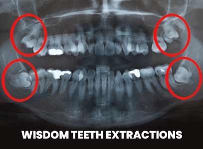 Wisdom Teeth Extraction/Oral Surgery Near Me in San Jose CA