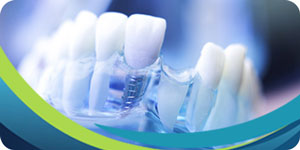 Health Benefits of Dental Implants Near Me in San Jose CA