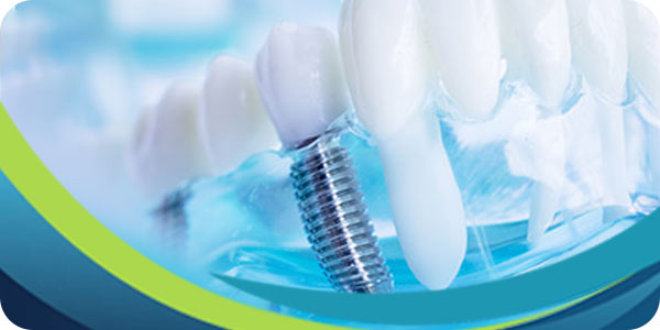 Cost of Dental Implants Near Me in South San Jose, CA on Blossom Hill Rd