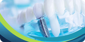 Cost of Dental Implants Near Me in South San Jose, CA on Blossom Hill Rd