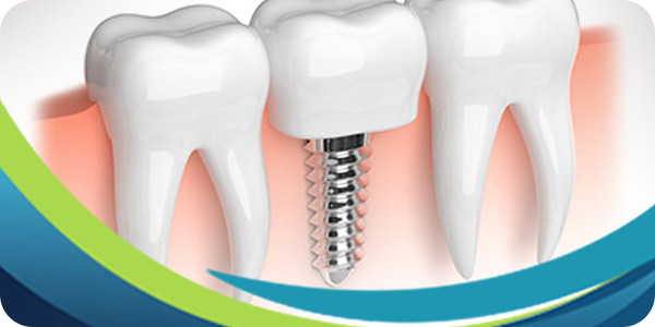 Dental Implant Surgery Specialist Near Me in San Jose CA