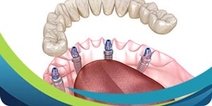 Implant Retained Dentures Specialist Near Me in San Jose CA