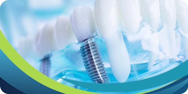 Types of Dental Implants Near Me in San Jose CA