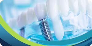 Root Canal vs. Single Tooth Implant Near Me in San Jose CA